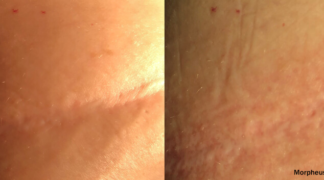 morpheus8 results images