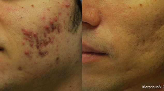 Morpheus8 before after acne scars