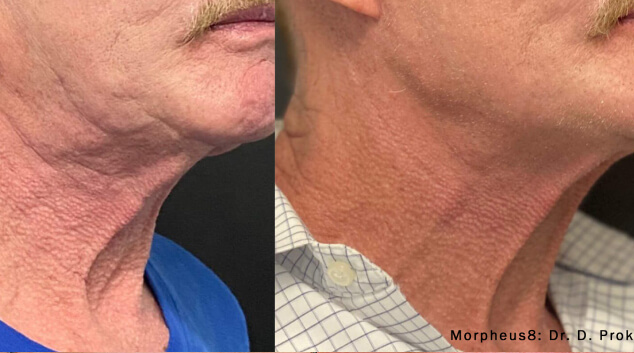 morpheus8 result for face