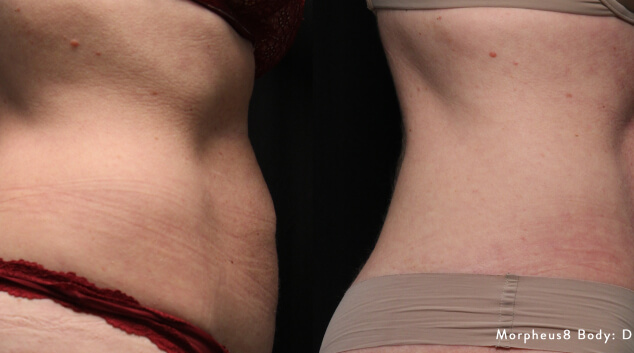 morpheus8 before and after