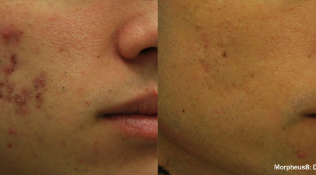 morpheus8 results for acne scars