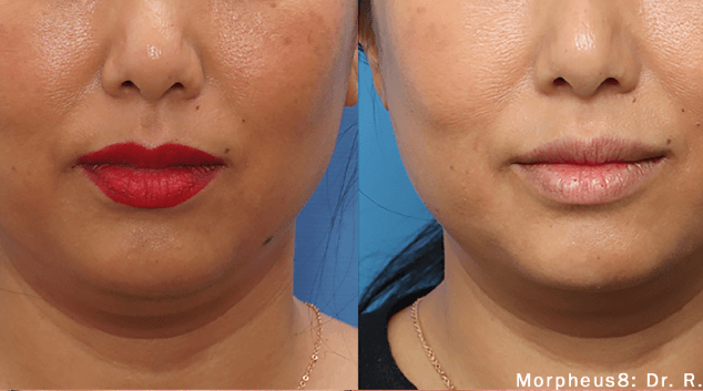 morpheus8 before & after