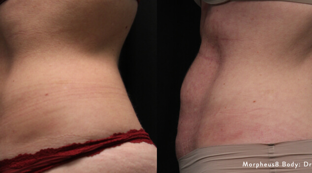 morpheus8 results before & after