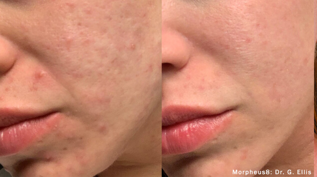 results of morpheus8