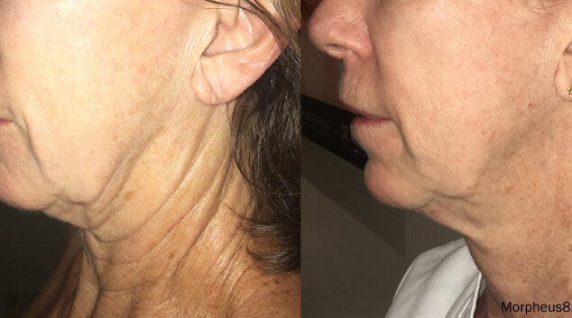 morpheus8 neck results