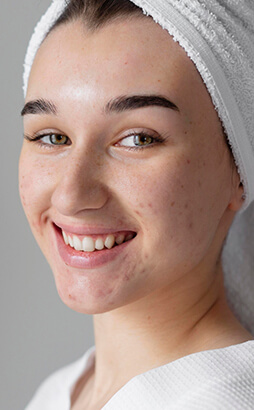 acne treatment